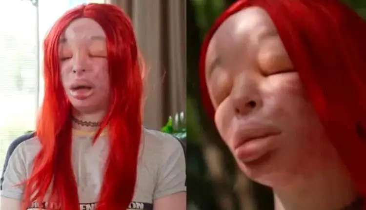 هوس التجميل يدمر وجهها.. فتاة بولندية تستيقظ بوجه...