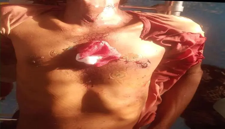 سمكة "أبو سيف" تهاجم صياد أثناء عودته من رحلة رزق...