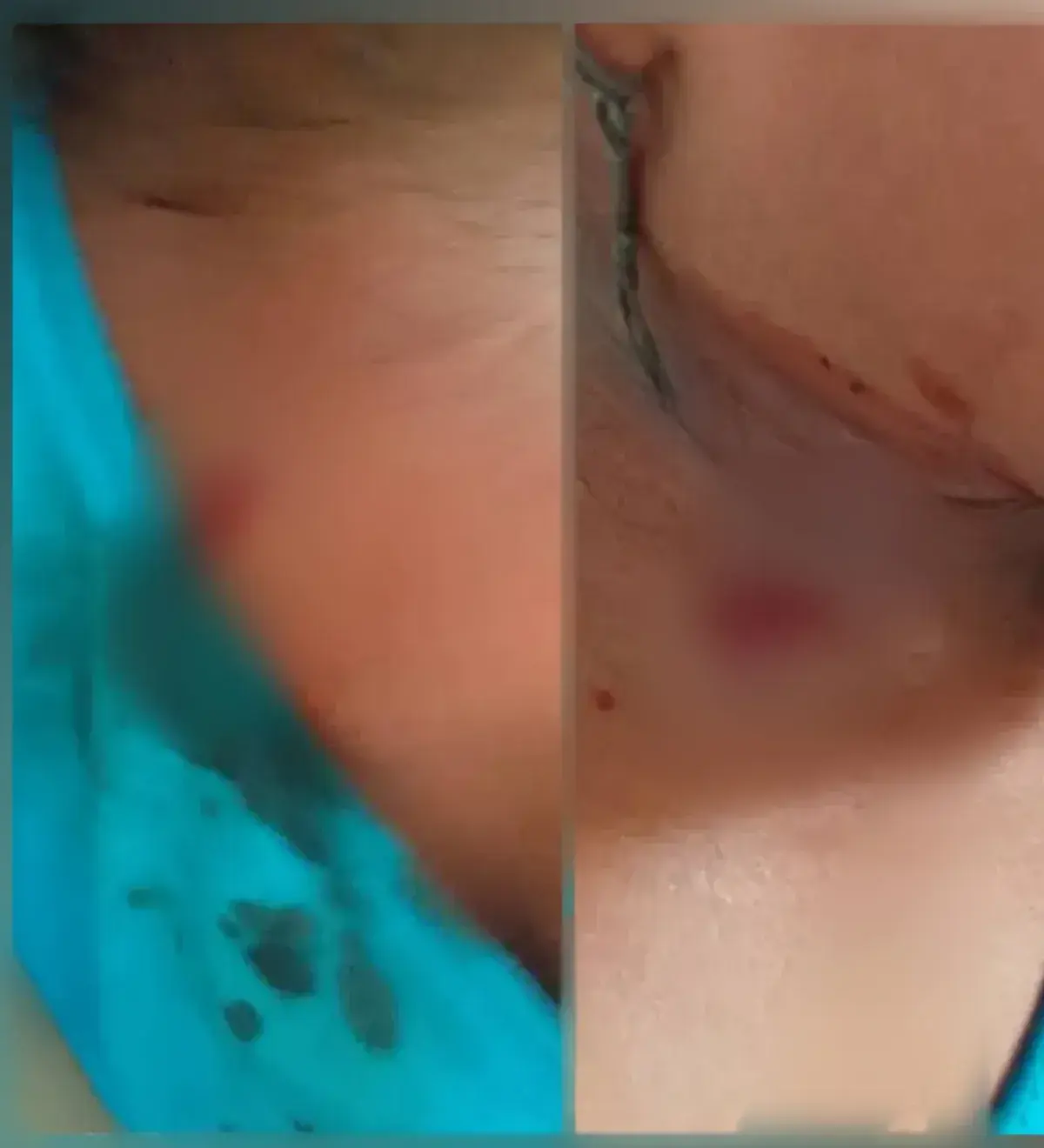 إصابة طفلة برصاص قناصة مليشيا الحوثي الإرهابية في...