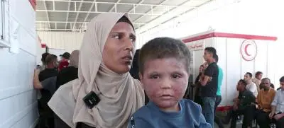 9300 مصاب بأمراض جلدية في غزة