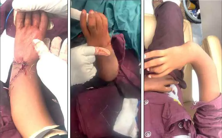 إنجاز طبي غير مسبوق في اليمن.. جراح يمني في عدن ينهي معاناة طفل من تشوه خلقي معقد بعد 13 عاماً من المعاناة