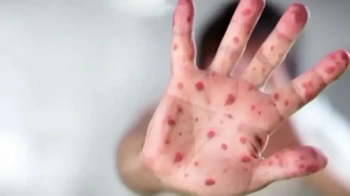 صحة مأرب: نحو 1.5 ألف إصابة و10 وفيات بالحصبة منذ مطلع العام الجاري