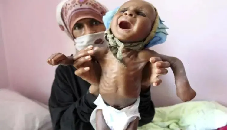 الجوع ينخر مناطق الحوثي والأمم المتحدة تحذر
