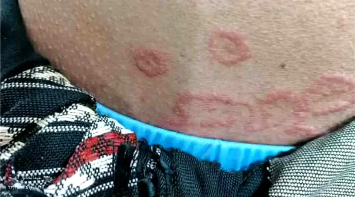 مرض جلدي يتفشى في الزهرة بالحديدة ومخاوف من توسع ا...