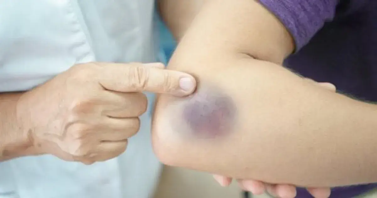ظهور الكدمات المتكررة.. متى يجب استشارة الطبيب؟