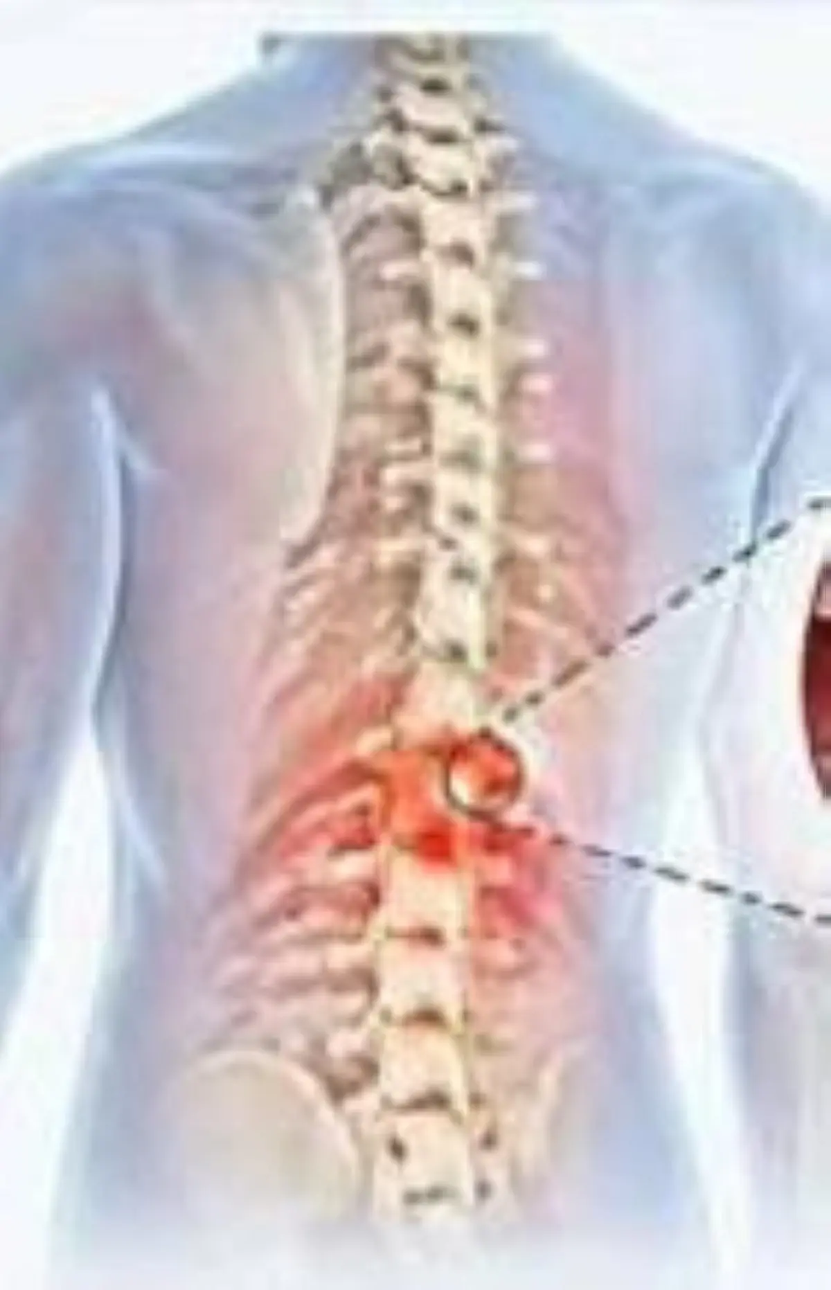 شريحة قابلة للتحلل تعالج جلطات العمود الفقري